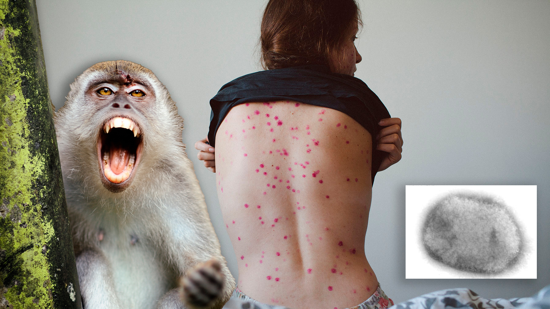 Se detectó el primer caso de viruela del mono en Uruguay