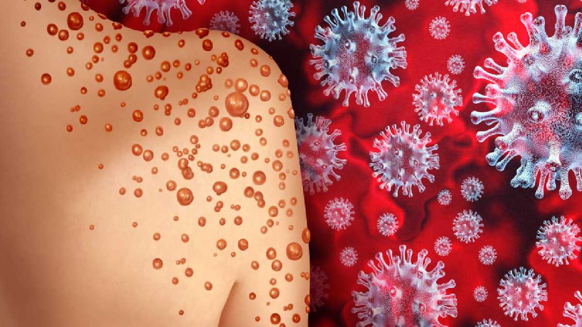 Detectan primer caso de viruela símica en Egipto