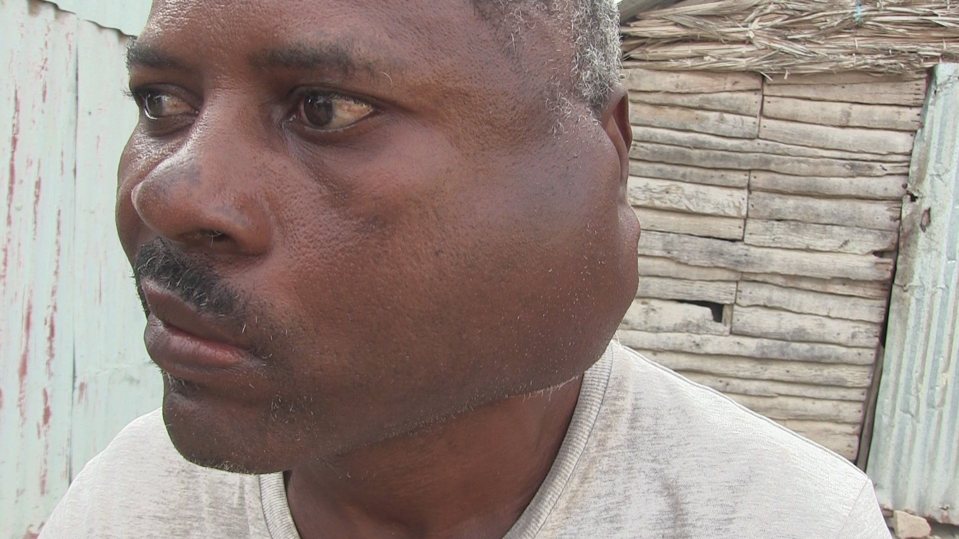 Ciudadano haitiano pide ayuda para erradicar extraña enfermedad en su rostro