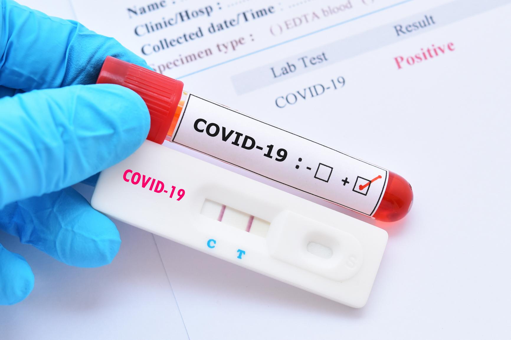 Siete casos de COVID-19 son reportados por Salud Pública