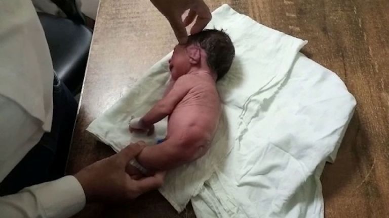 Bebé prematuro nace con un cuerno en lugar de piernas