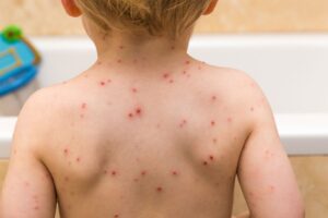 Alertan sobre eventual brote de varicela en el país