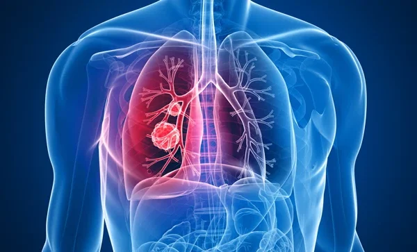 Los avances en inmunoterapia y terapias dirigidas, transformando el panorama del tratamiento del cáncer de pulmón en el país, ofreciendo nuevas esperanzas. / Fuente externa.