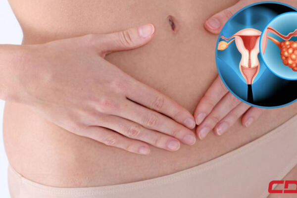 Síndrome de Ovarios Poliquístico lo que debes conocer. Fuente: CDN Digital 