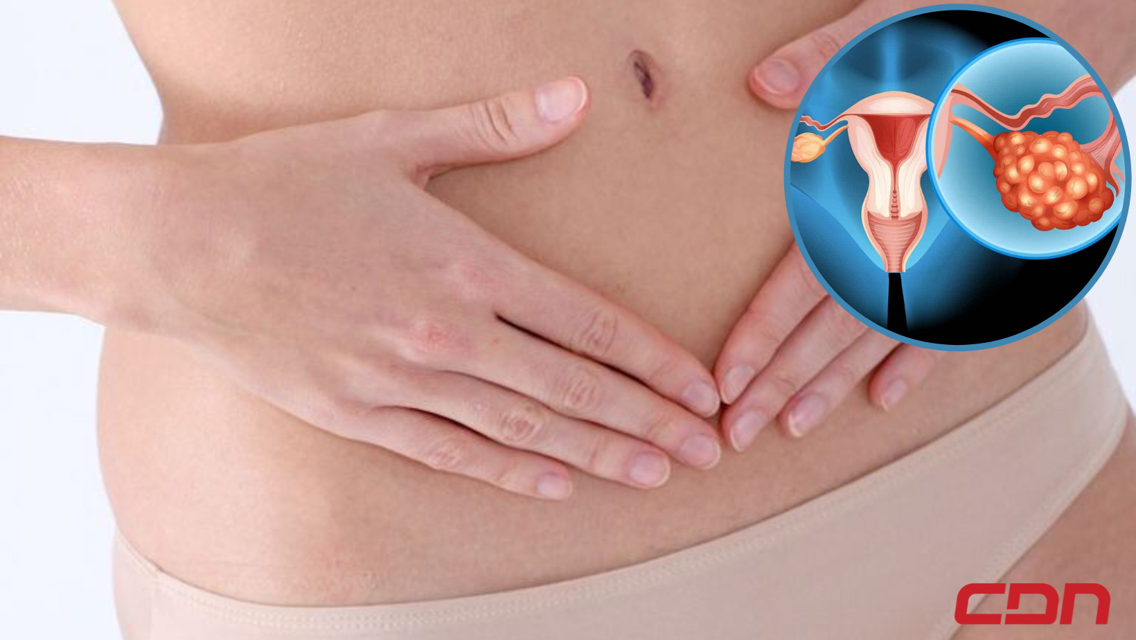 Síndrome de Ovarios Poliquístico lo que debes conocer