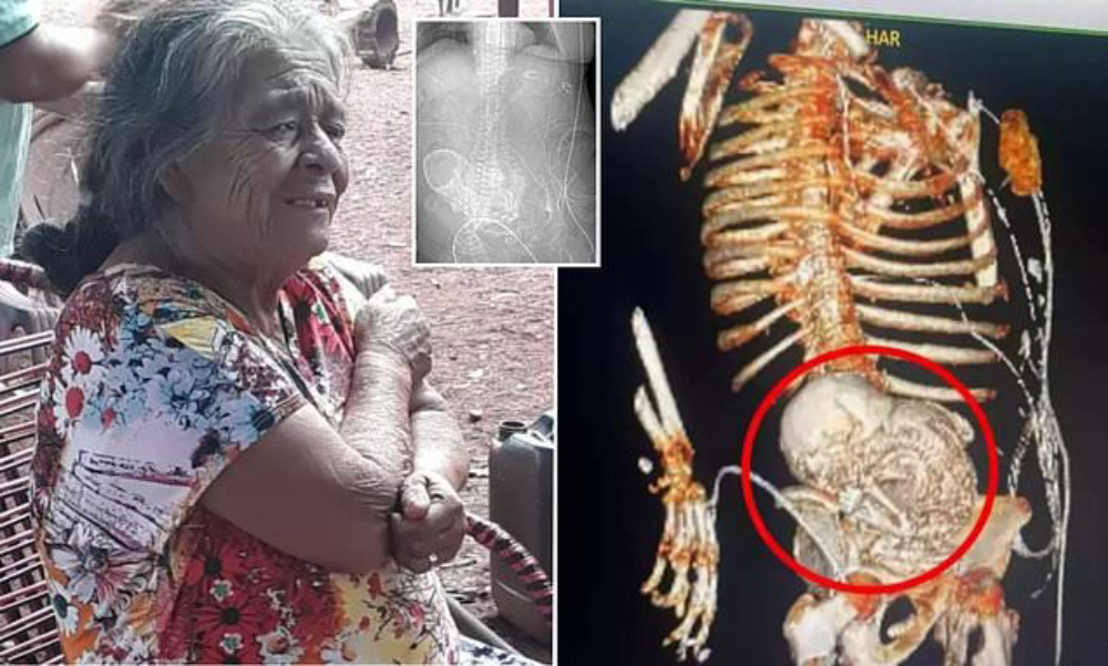 Anciana tenía en su cuerpo un bebé de piedra desde hace 56 años