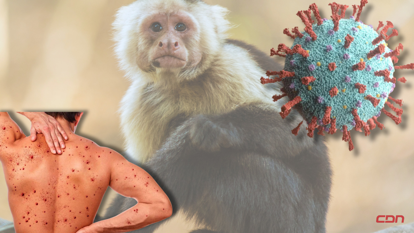 Virus de la viruela del mono. Foto: CDN Digital