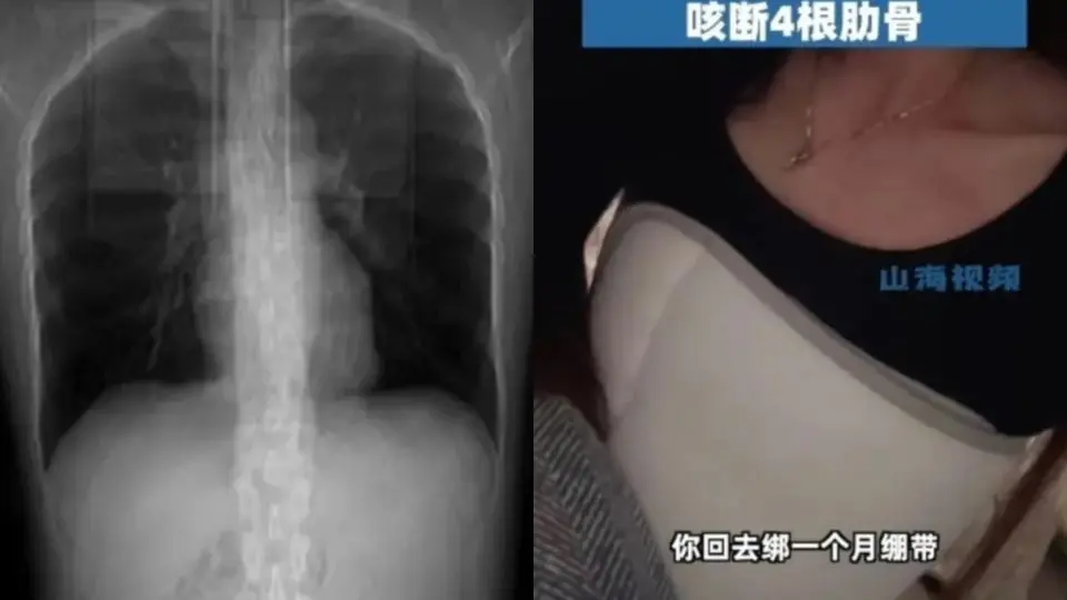 Mujer estornuda después de comer picante y se rompe cuatro costillas