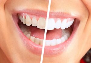 Cómo blanquear tus dientes de forma natural y sin químicos