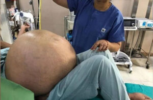 Extirpan un tumor de más de 50 kilos del abdomen de una mujer en Italia