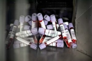 Covid persistente: identifican posibles biomarcadores en sangre para su diagnóstico