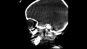 La aguja migró de la cavidad oral al cerebro por un pequeño agujero al cerebro de una niña de 4 años, que tras ser intervenida se recuperó satisfactoriamente