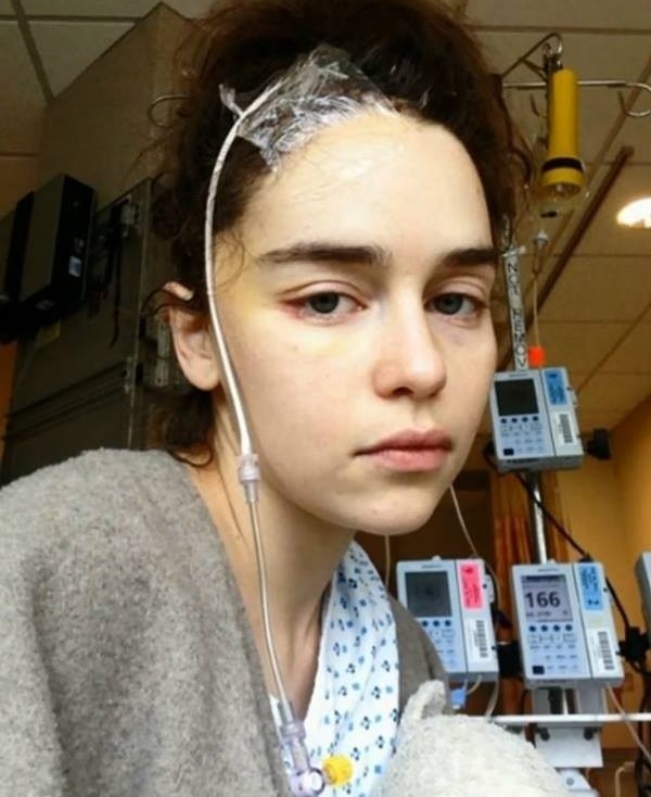 aneurisma cerebral emilia clarke