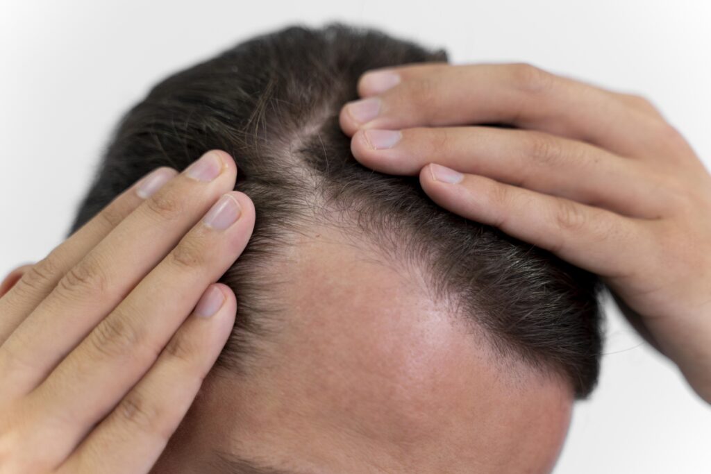 Alopecia masculina