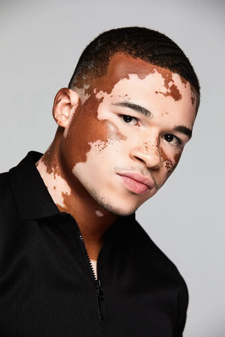 Vitíligo